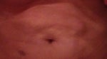 Hard Lumps After Smartlipo - Is It Normal?