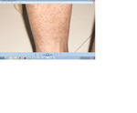 Cause of pigmentation