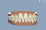 Can this be the final result of Invisalign?