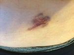 raised, red and bumpy 4 days post second treatment