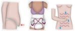 tummy tuck images
