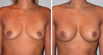 essentials to getting great breast implants