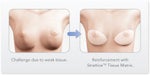 breast augmentation problem