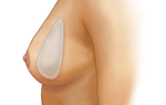 Sientra Breast Implants Overview