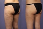 Actual results from a patient treating cellulite with Cellulaze.