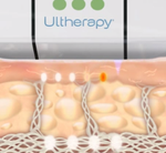 Video on how ultherapy works