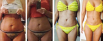 Liposuction Overview