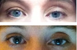 Considering revision for Cong Ptosis Surg. - thoughts?