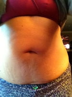 2 days post op mini TT, hernia repair and laser lipo