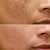 A Real Guide to Skin Resurfacing