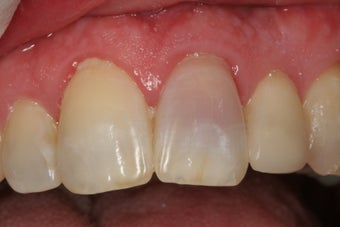 Internal Bleaching of Non-Vital Tooth photo from Gary Nack, DDS ...