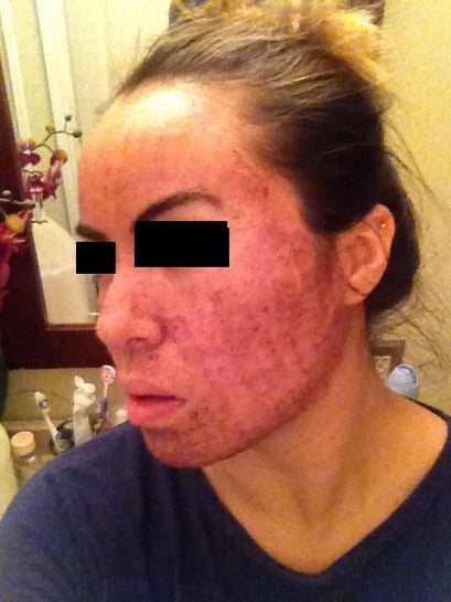 home fraxel laser reviews