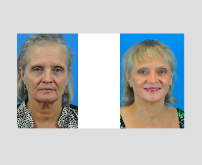 Hamilton Facial Plastic Surgery