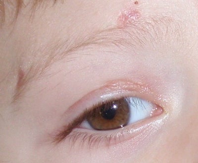 Will my Son's Scar on His Eye Crease Go Away? (photo) Doctor Answers, Tips