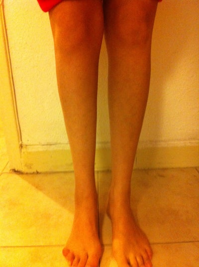 Fat Transfer to Lower Leg? (photo) Doctor Answers, Tips