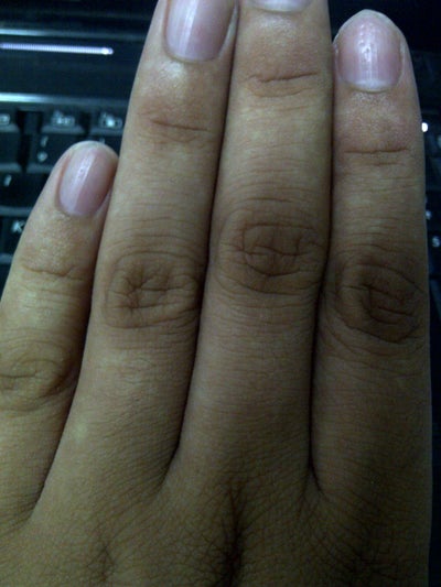 White Small Spots on Fingers That Fluctuate? (photo) Doctor Answers, Tips