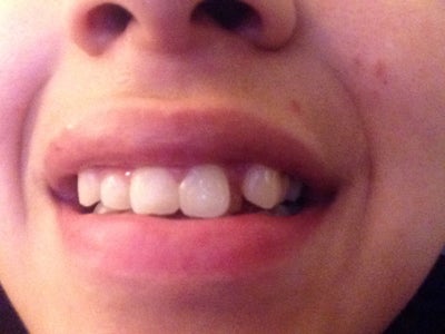 My L Cuspid tooth is behind my front main teeth and was wondering how ...