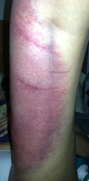 Is a Red Bruising Common to Have After Feathering During Liposuction ...