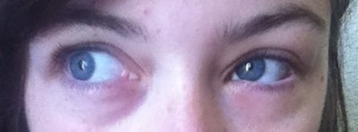 Can Anything Be Done to my Eye? (photo) Doctor Answers, Tips