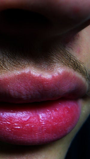 Vermilion Border Spikes on Upper Lip, Options to Remove Them? (photo ...