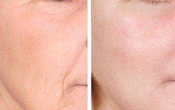 TCA Chemical Peel Worth it? Reviews, Cost, Pictures - RealSelf