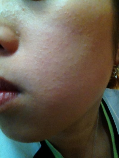 How do I get rid of these rough tiny bumps all over my face and get ...