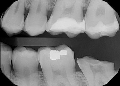 Why did my Cerac crown come off? (Photo) Dentist Answers, Tips